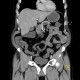 Ankylosing spondylitis, Bechterew's disease, Crohn's disease: CT - Computed tomography
